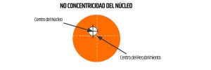 No concentricidad del núcleo